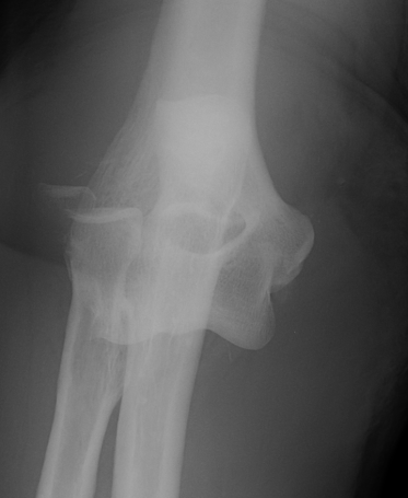 Complex Elbow Dislocation AP